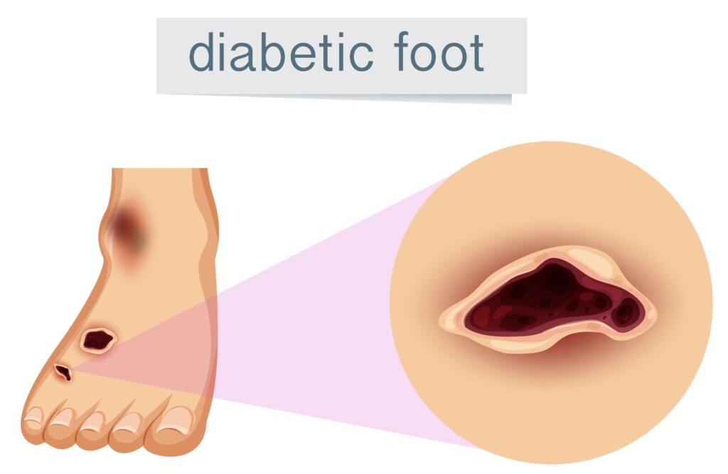 The Complete Guide to Diabetic Foot Care: Prevention, Symptoms, and Treatment